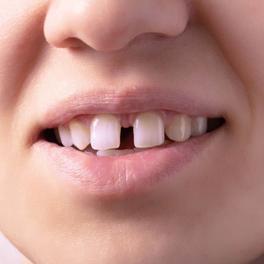 ¿Puedo Usar Brackets Si Mis Dientes Están Separados? ALINEA VISION DENTAL